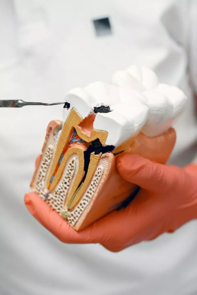 Cracked Teeth Treatment Grande Prairie Dentist Boisson Dental Group